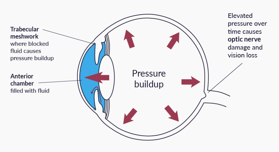 Exploring Eye Pressure and the Eye Puff Test