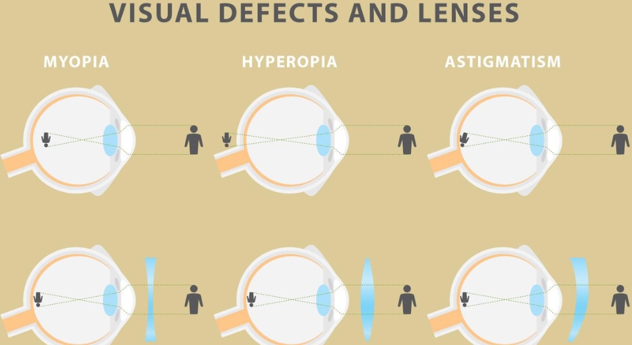 How light is bent on the retina