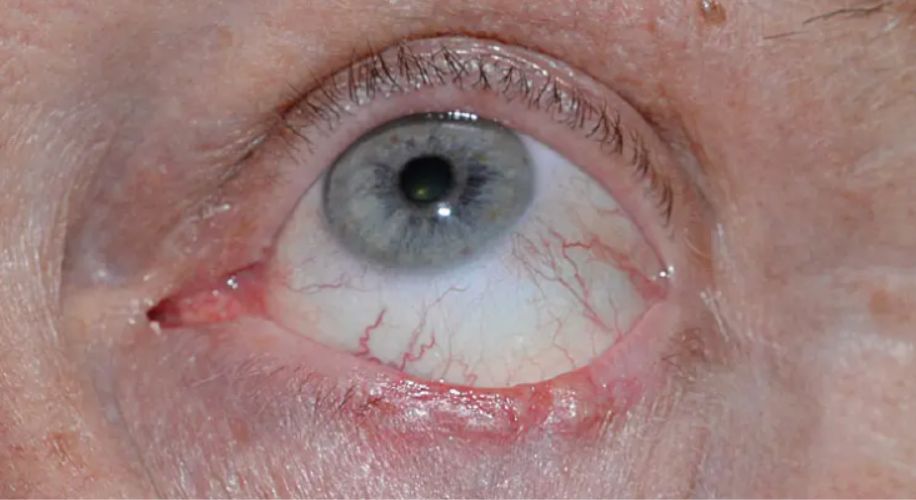 Close-up of an eye with visible redness, notable blood vessels, and irritated lower eyelid.