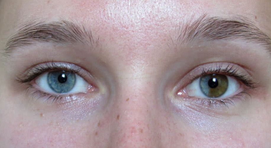 Close-up of a person with one blue eye and one brown eye.