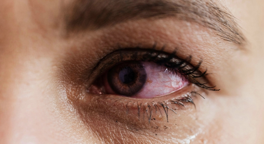 Close-up of a human eye with visible redness and irritation.