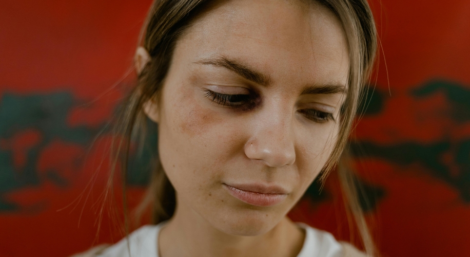 Woman with light bruising under her eye, looking down, against a red background.