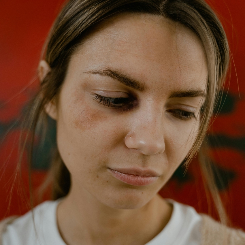 Woman with a bruise under her eye, looking down.